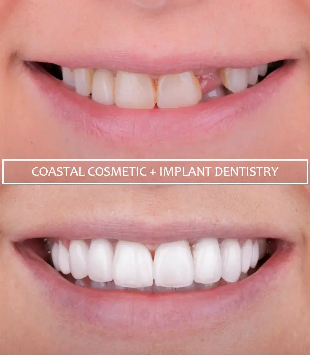 Before and after removing a tooth and replacing it with a dental implant